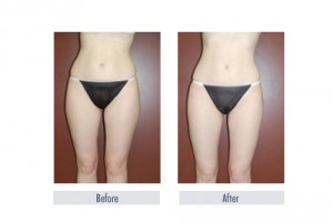 How Much Does Liposuction Cost Las Vegas