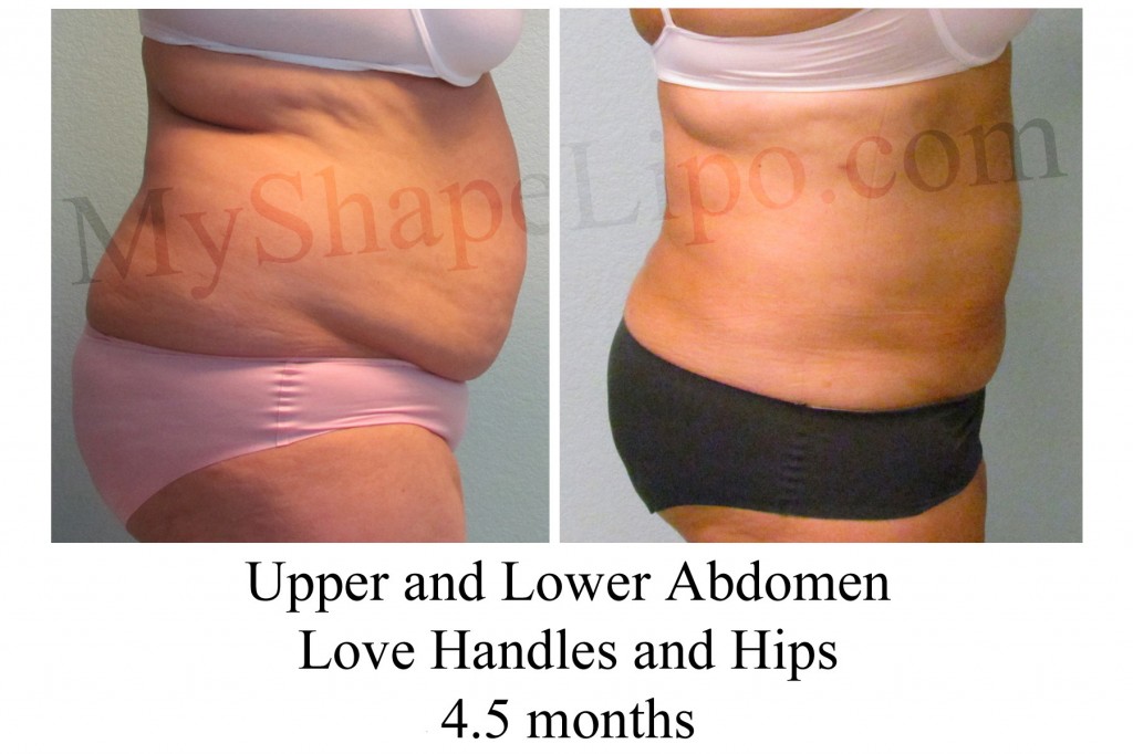 B-A UL abd, LH, Hips from side MG 4.5 months cr