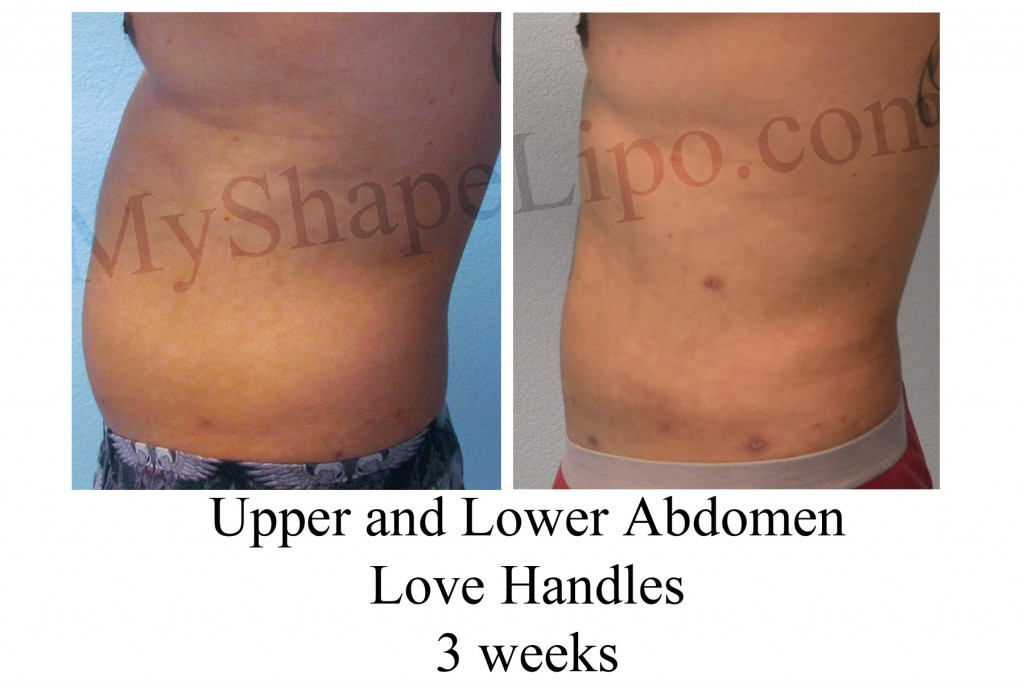 MyShape Lipo 702.818.5476 www.myshapelipo.com